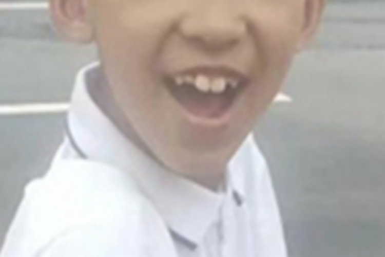 腺样体肥大大门牙前突图