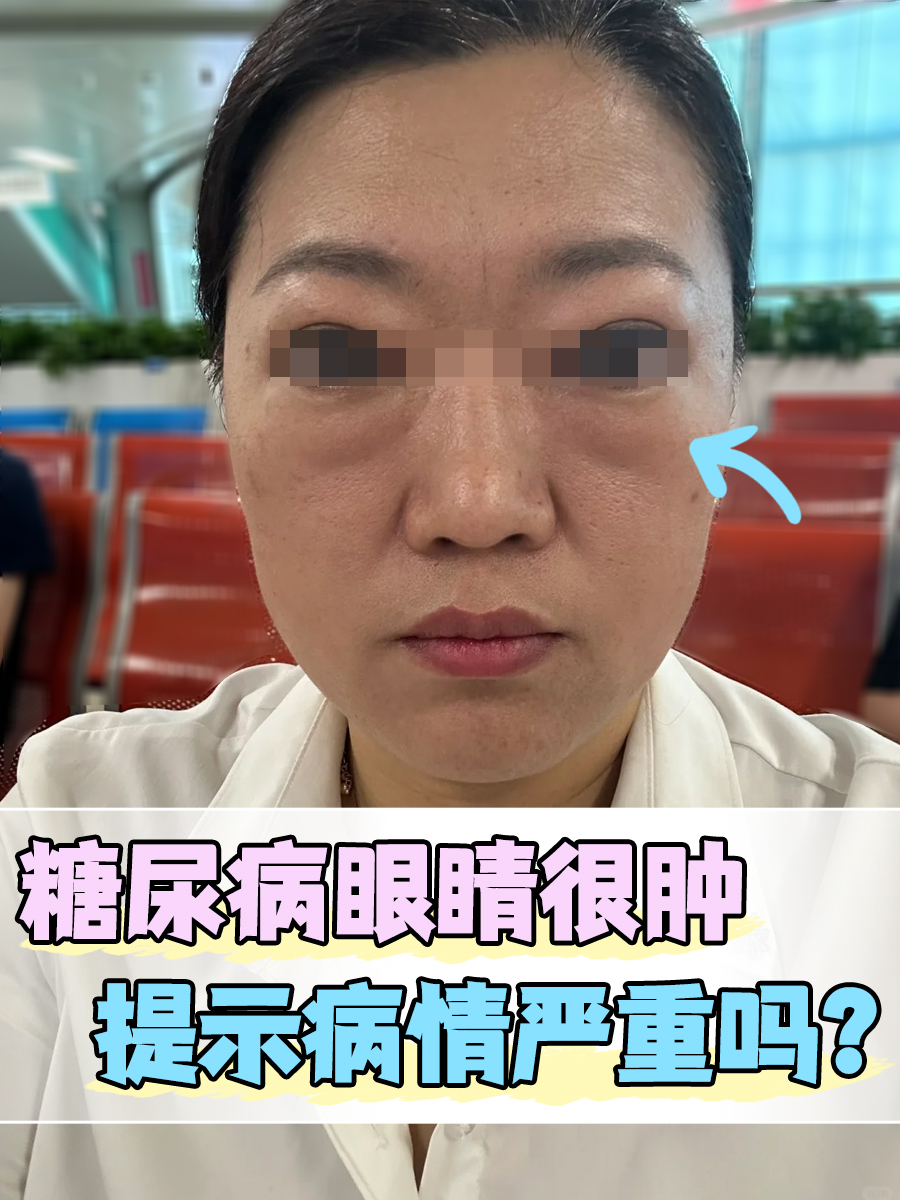 糖尿病眼睛很肿,提示病情严重吗?