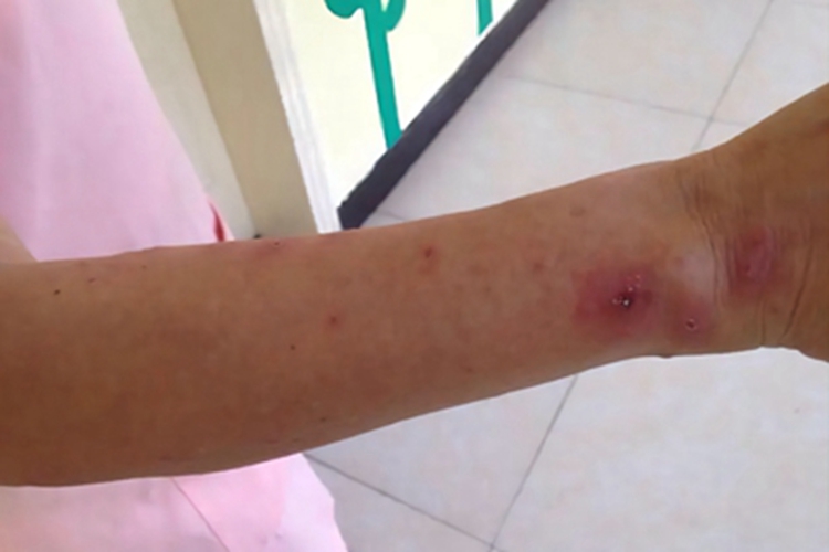 蚁蜇伤胳膊长红斑结痂图