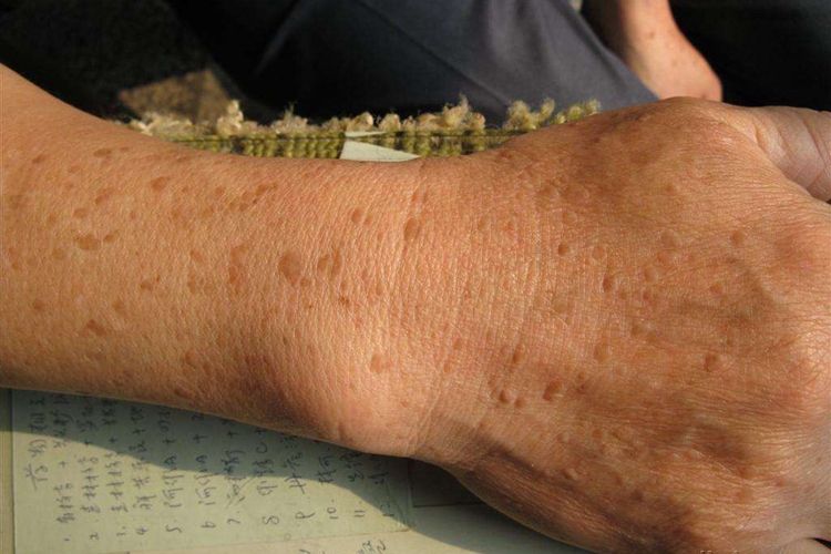 日光性角化病图