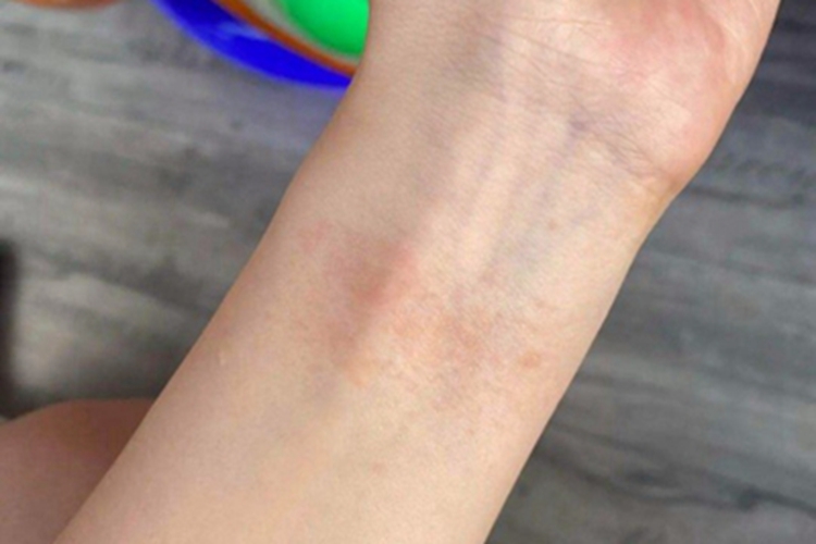 镍皮炎胳膊症状图