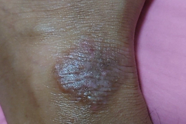 慢性湿疹脚踝结节图 慢性湿疹脚踝结节图