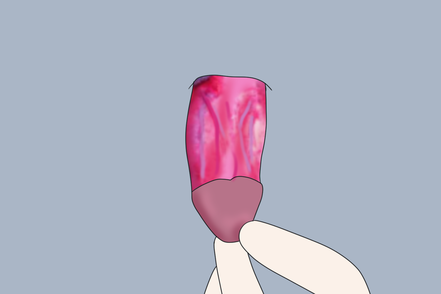 阴茎根部皮肤切除术图