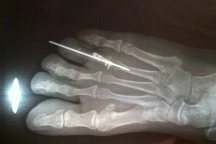 脚趾骨折打钢钉影像学图 脚趾骨折打钢钉影像学图