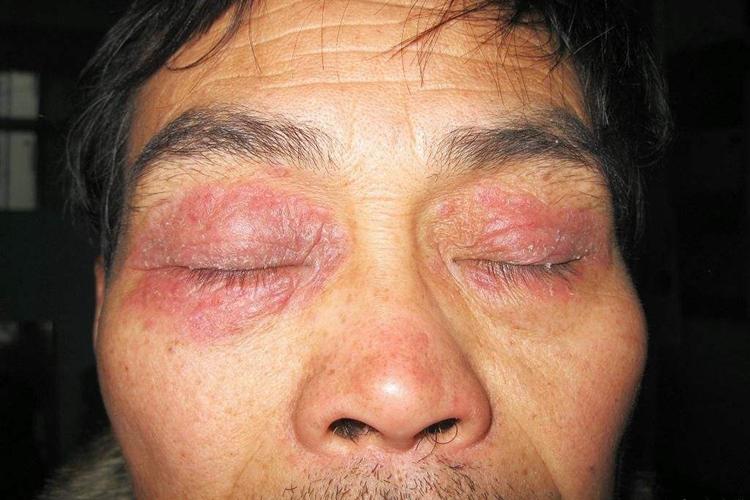 眼皮神经性皮炎图