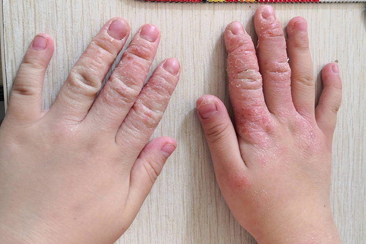 儿童期特应性皮炎图