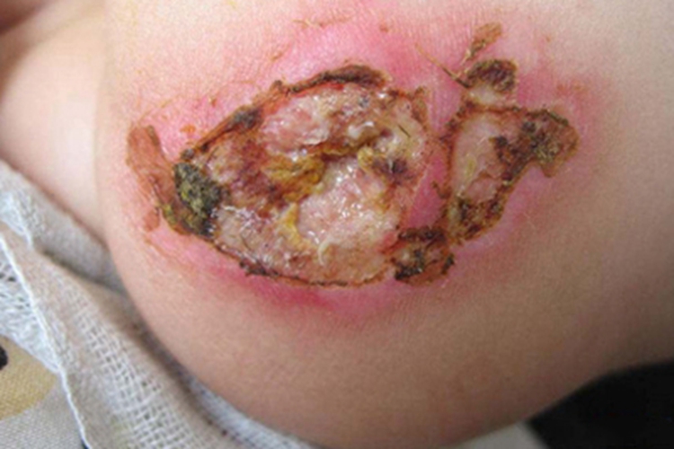 脓疱疮脚后跟结痂图 脓疱疮脚后跟结痂图