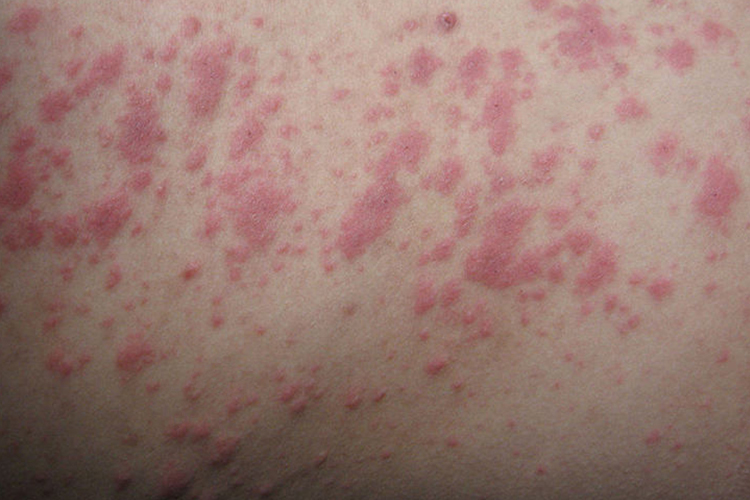 水肿性丘疹图