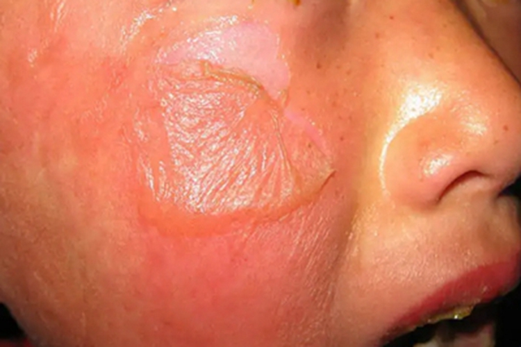 大疱性表皮松解症面部水疱图 大疱性表皮松解症面部水疱图