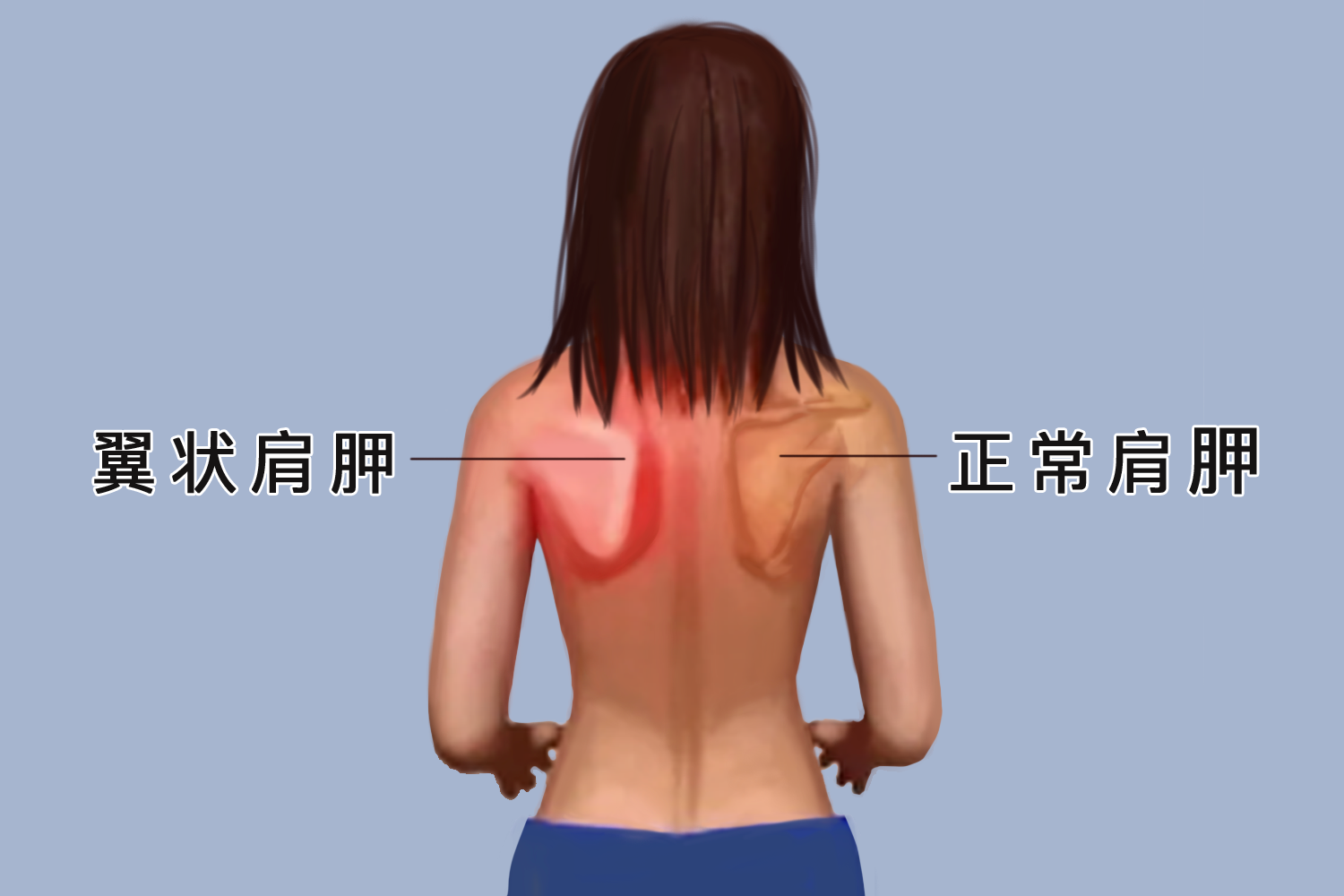 翼状肩和正常肩图