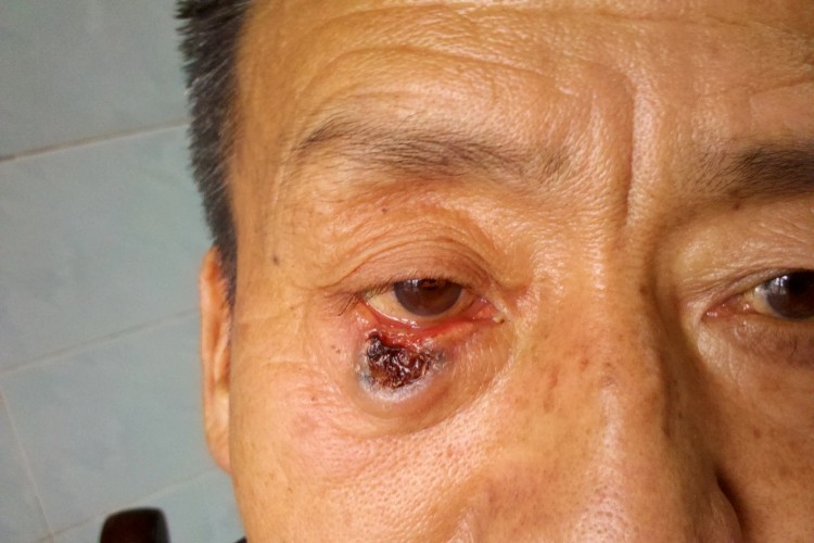 眼睑基底细胞癌图