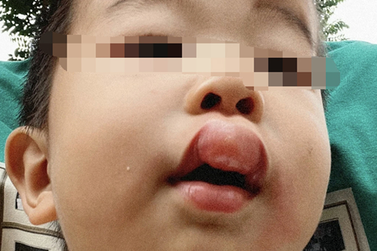 蜜蜂叮蛰嘴唇肿大图