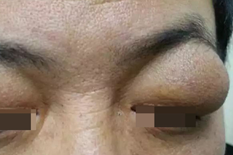 泪腺脱垂上眼睑严重肿胀图