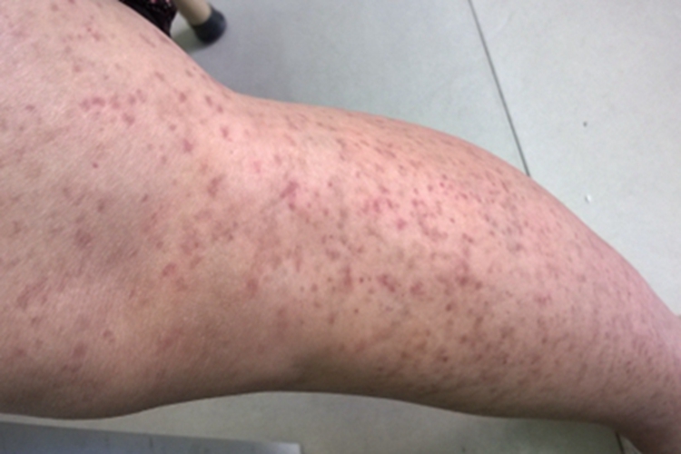 流行性斑疹伤寒症状图