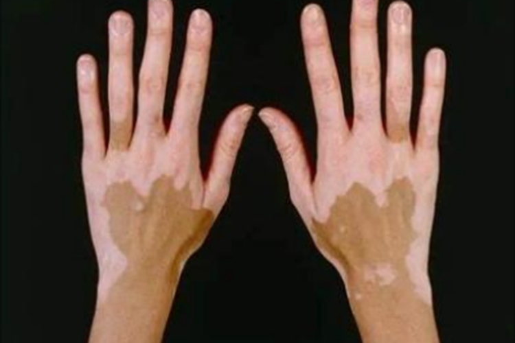 非节段型白癜风手部症状图