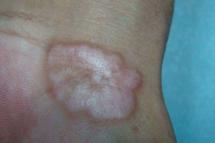 环状肉芽肿手腕症状图