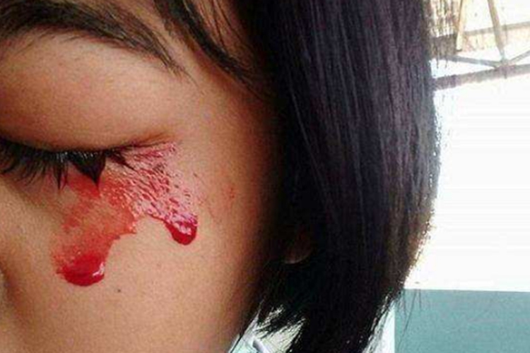 高血压性视网膜病变眼睛流血图