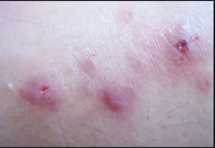 女性梅毒初期症状图片图片