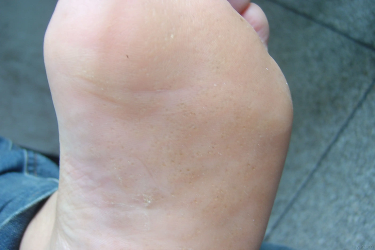 点状角化发生在掌跖图 点状角化发生在掌跖图