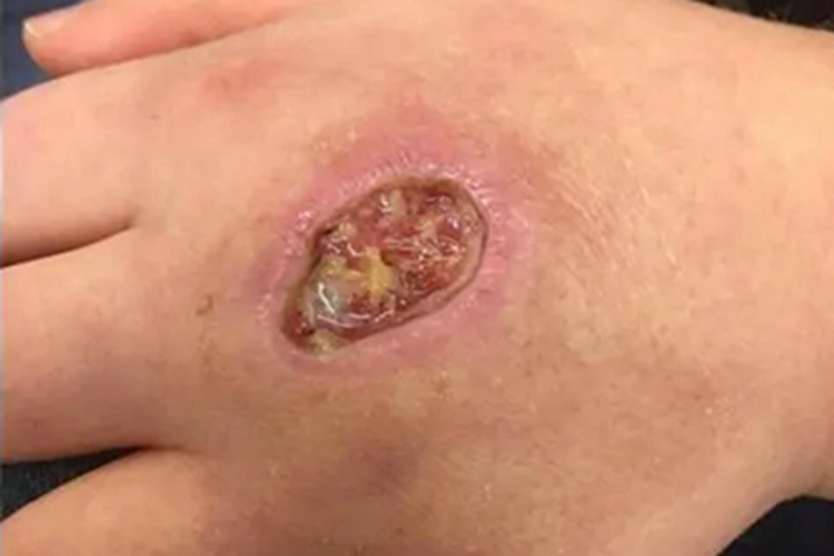 利什曼病手背化脓图 利什曼病手背化脓图