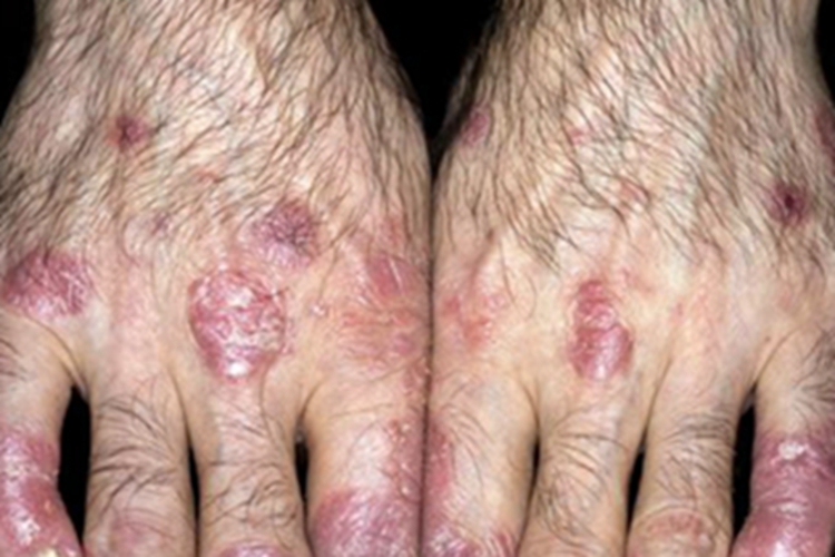 关节病型银屑病手背症状图 关节病型银屑病手背症状图