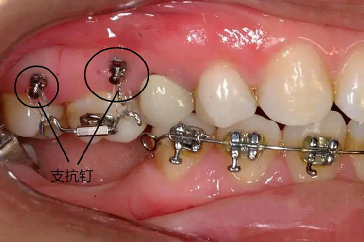 正畸支抗钉图 正畸支抗钉图