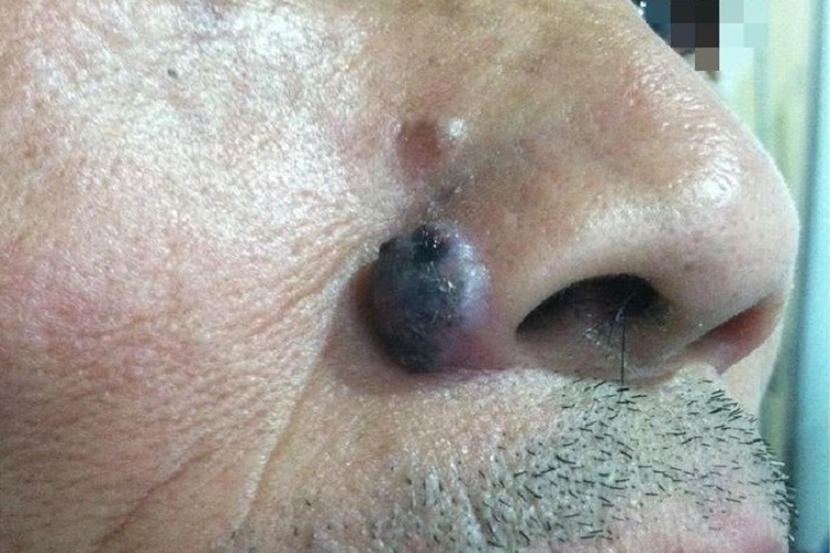 结节型基底细胞瘤鼻翼紫斑图 结节型基底细胞瘤鼻翼紫斑图