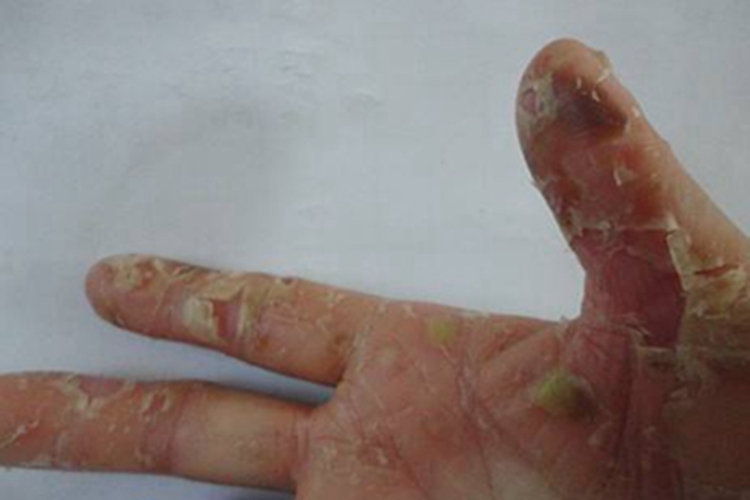 深脓疱疮脱皮图 深脓疱疮脱皮图