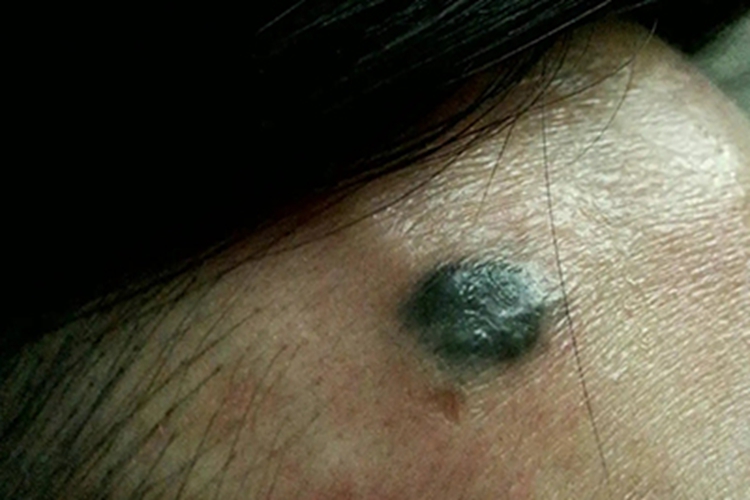 头部黑色色素痣图