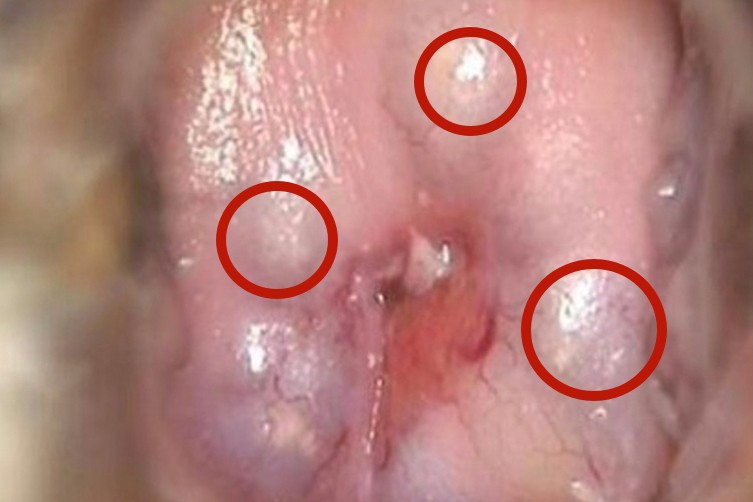 宫颈外面长了囊肿图