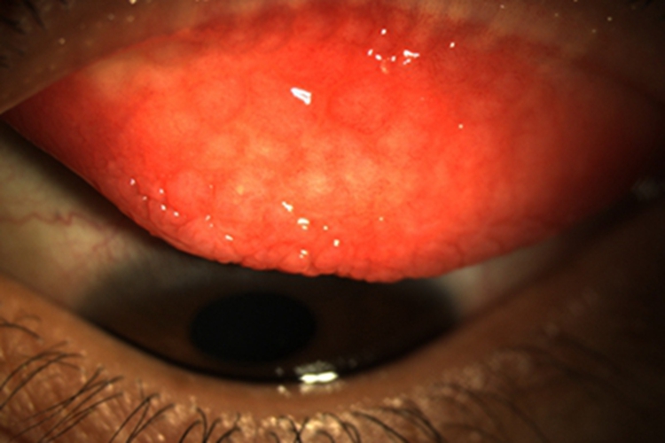 特应性角结膜炎症状图 特应性角结膜炎症状图