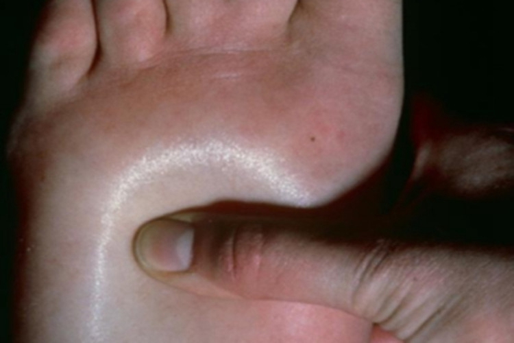 黏液性水肿脚部肿图