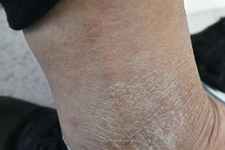 干性湿疹脚踝症状图