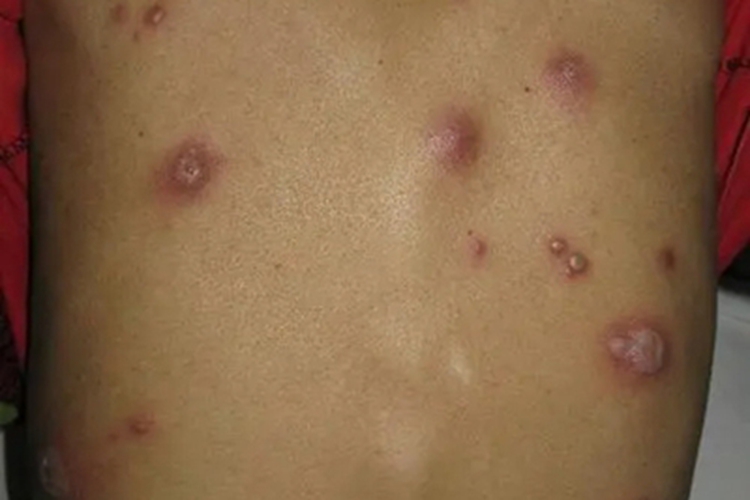 念珠状链杆菌型鼠咬热脓包图 念珠状链杆菌型鼠咬热脓包图