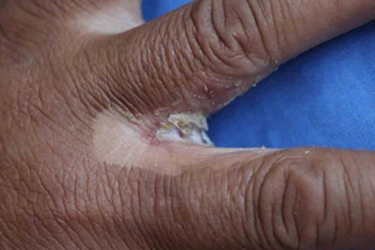 念珠菌性间擦疹手指缝脱屑图 念珠菌性间擦疹手指缝脱屑图