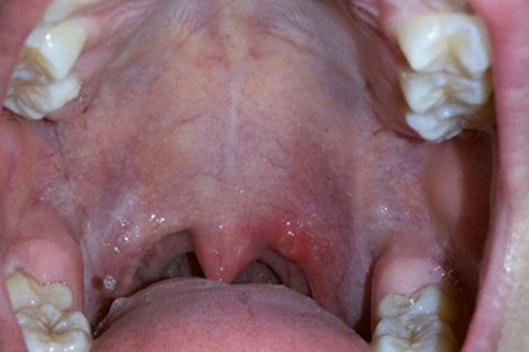 艾滋病初期咽喉炎发红图