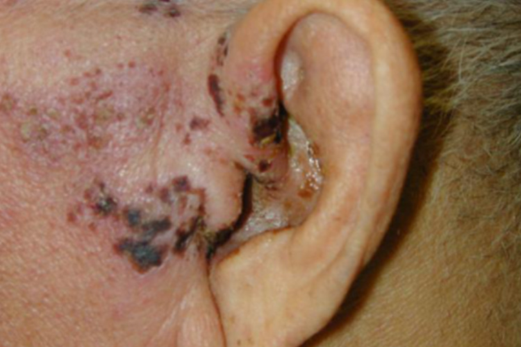 外耳恶性黑色素瘤图 外耳恶性黑色素瘤图