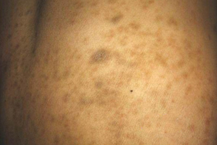 皮肤白血病背部黑斑图