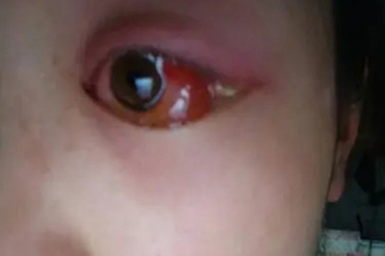 流行性角结膜炎眼球水肿图 流行性角结膜炎眼球水肿图