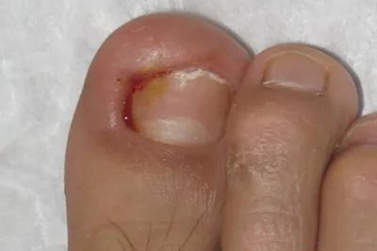 急性甲沟炎脚趾红肿图
