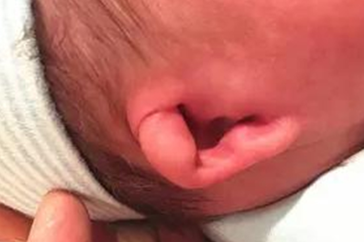 新生儿先天性中耳畸形图 新生儿先天性中耳畸形图