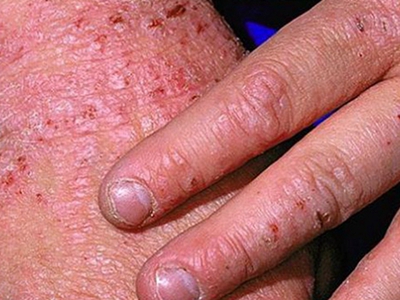 自体敏感性湿疹手背长淡粉色斑和血痂图jpg