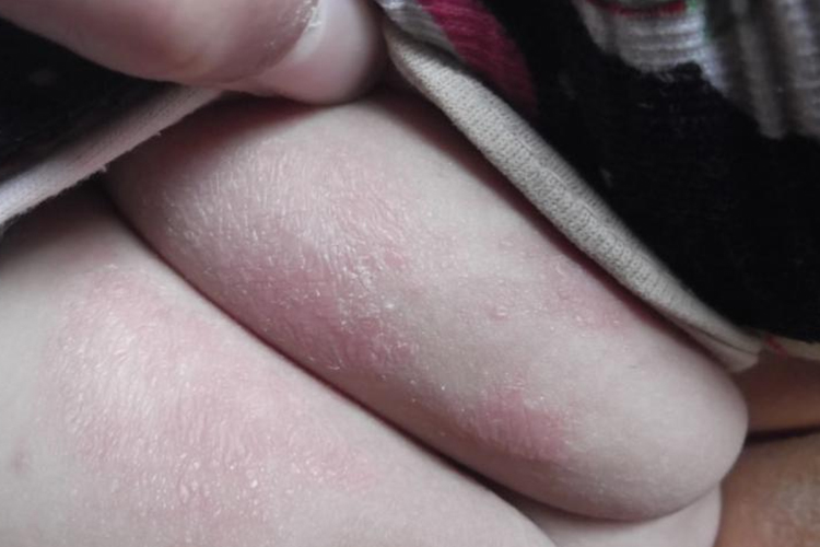 婴儿体癣红斑图 婴儿体癣红斑图