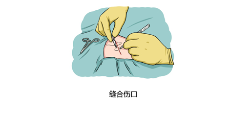 胸腔镜检查步骤