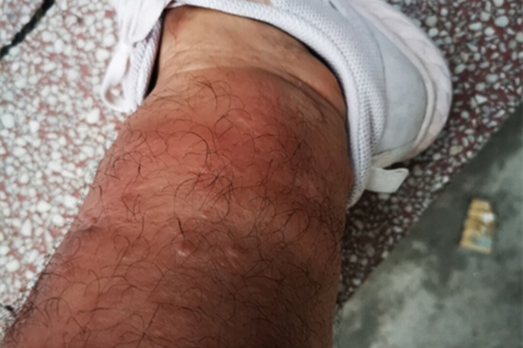 胫前黏液性水肿小腿红肿图