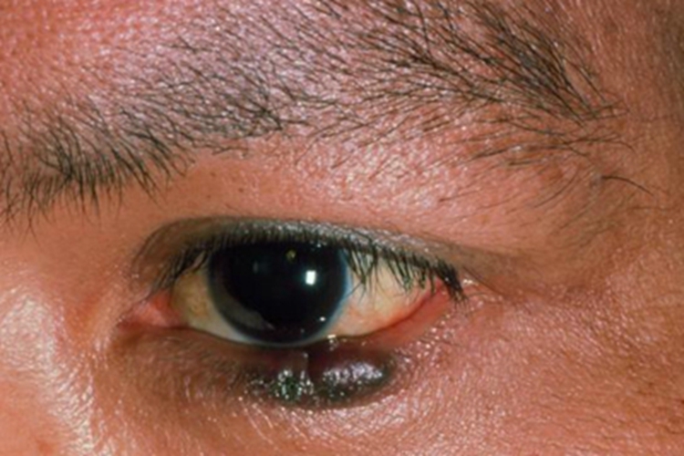 睑板腺癌下眼睑变黑图