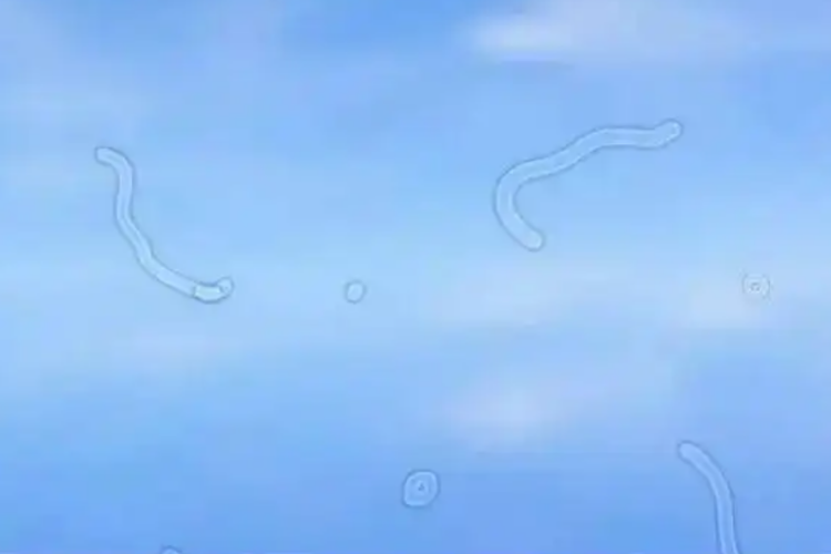 视网膜裂孔眼前出现漂浮物图