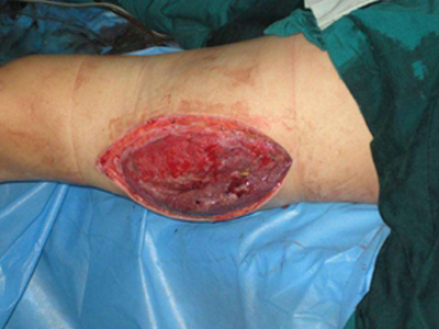 气性坏疽的症状和图片 - 有来医生