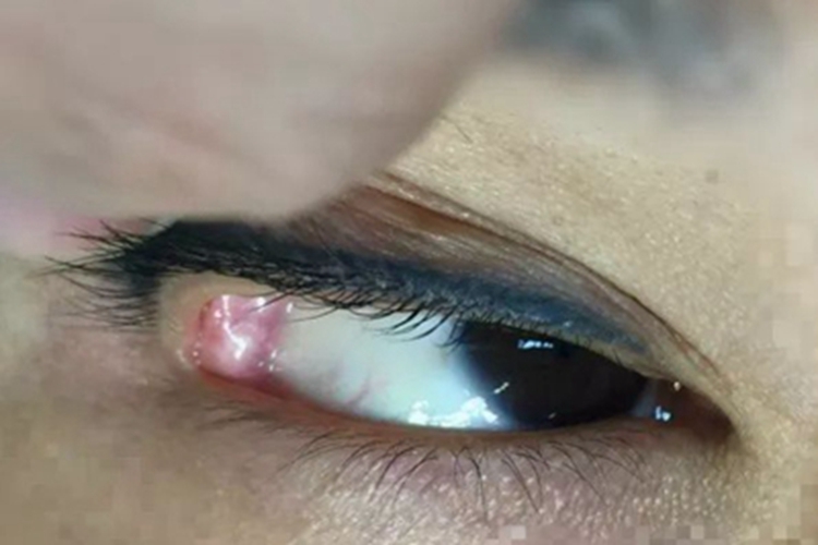 泪腺脱垂小疙瘩图