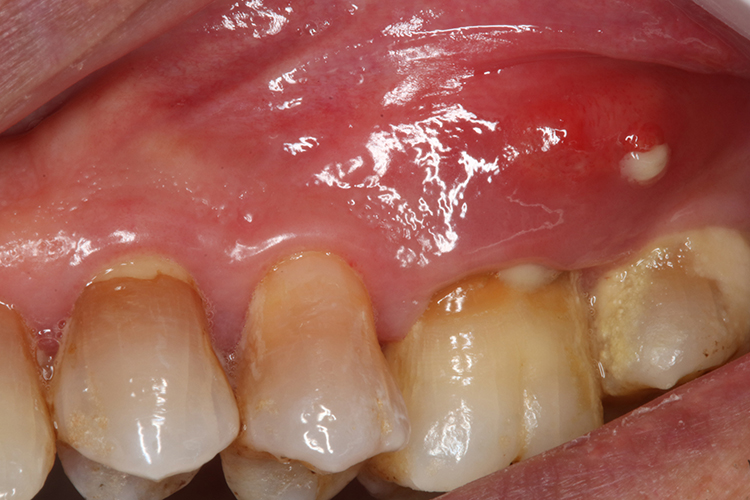 牙龈瘘管牙龈起白泡图